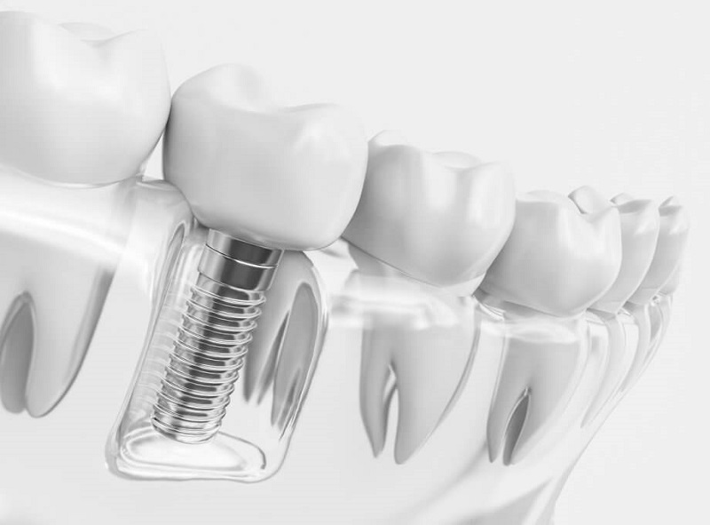 Dental-Implant.jpg