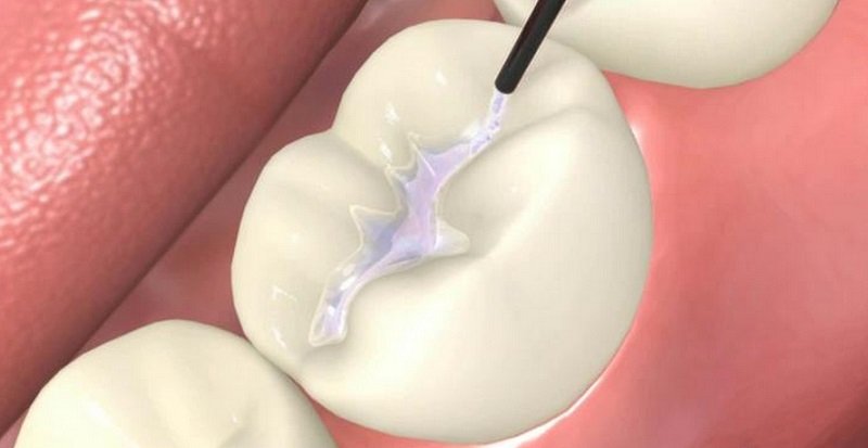 Dental-Sealants.jpg