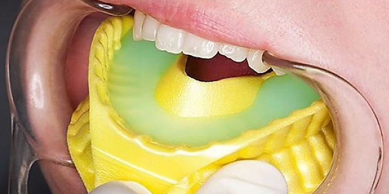 Fluoride-Treatment.jpg