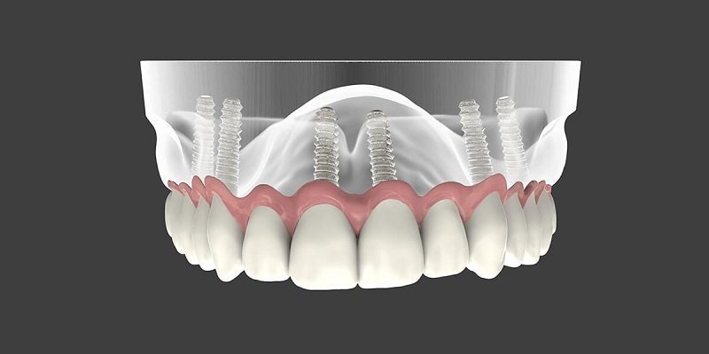 Full-Mouth-Reconstruction.jpg