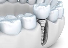 dental-implants.jpg