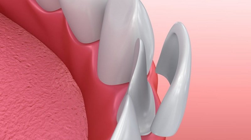 dental-veneers.jpg